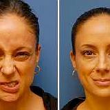 Correzione delle asimmetrie del volto